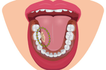 「舌がんの進行速度は速い？ 治療法や有効なケアを解説」記事内の画像