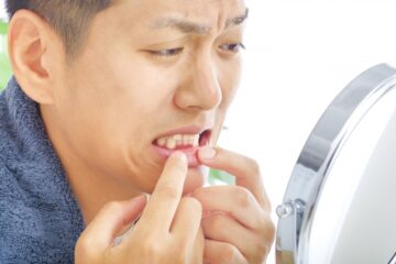 「口唇がんの初期症状とは？ 代表的な6つの治療方法を解説」記事内の画像
