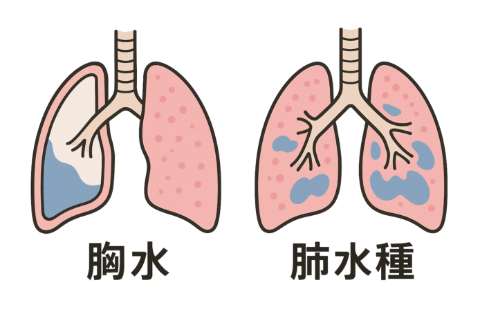 「高齢者の肺に水がたまった場合の余命とは？　胸水と肺水腫の違いも解説」記事内の画像