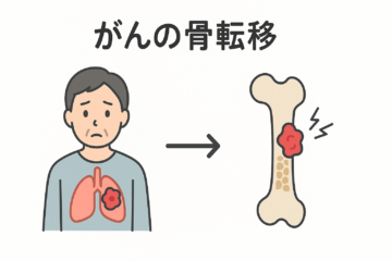 「骨転移の痛みとは？原因・症状・治療法まで徹底解説｜しびれや骨折も注意」記事内の画像