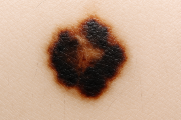 「悪性黒色腫（メラノーマ）とは？ほくろとの見分け方や症状、特徴、治療法など解説」記事内の画像