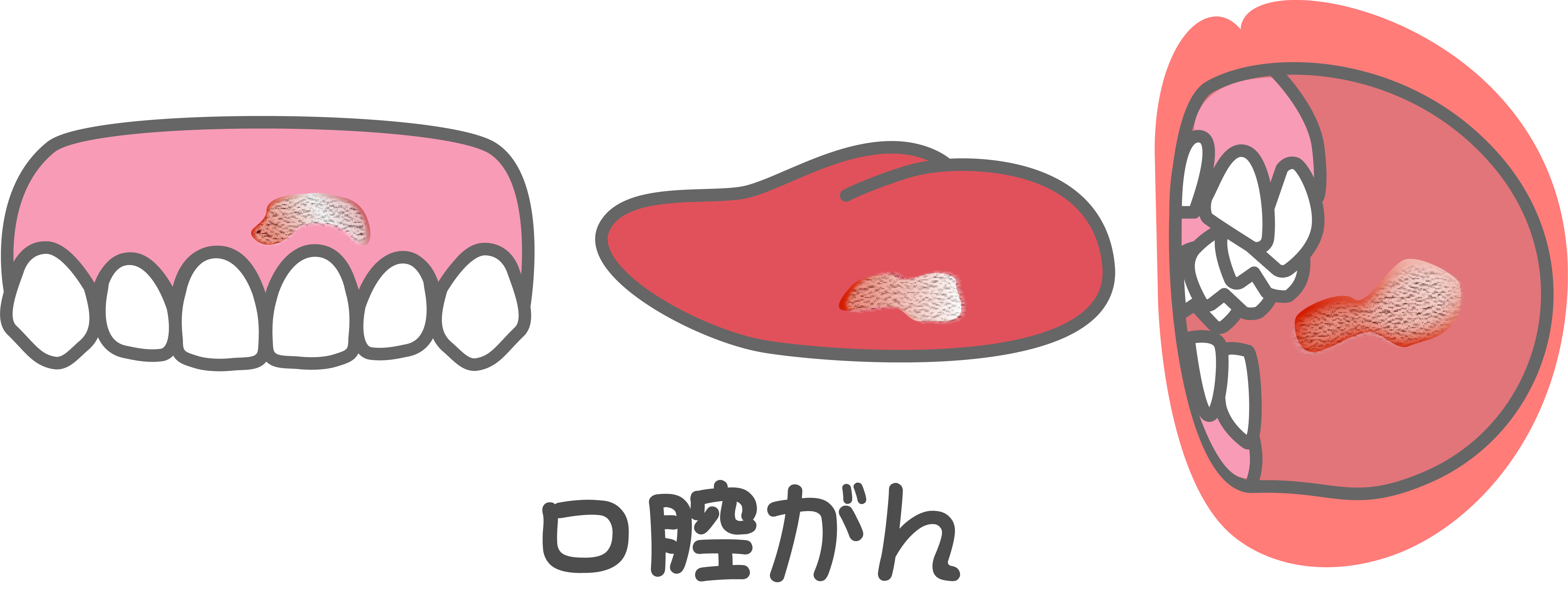 口腔がんとは