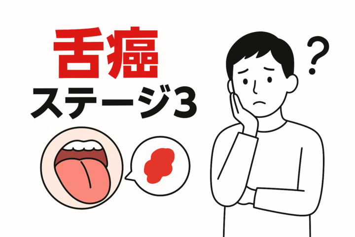 「舌癌のステージ3とは？余命や生存率・症状・治療法をわかりやすく解説」記事内の画像
